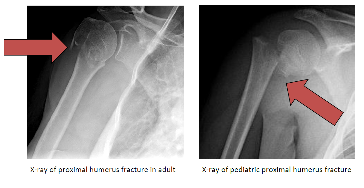 Proximal Humerus Fracture Broken Shoulder Orthopaedic - vrogue.co