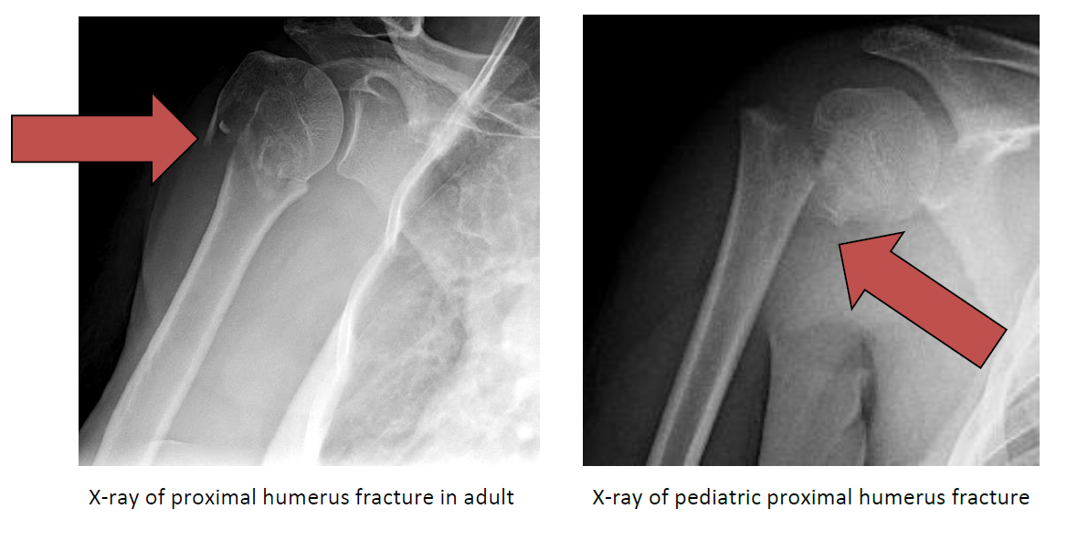 Types Of Proximal Humerus Fractures - vrogue.co