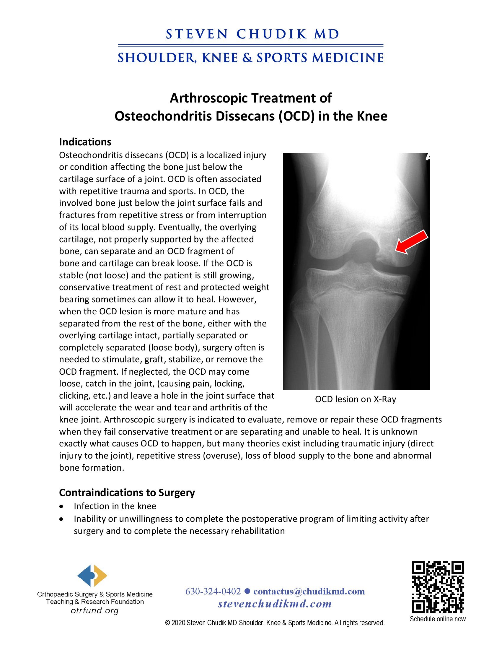 Arthroscopic Treatment of Osteochondritis Dissecans (OCD) in the Knee ...