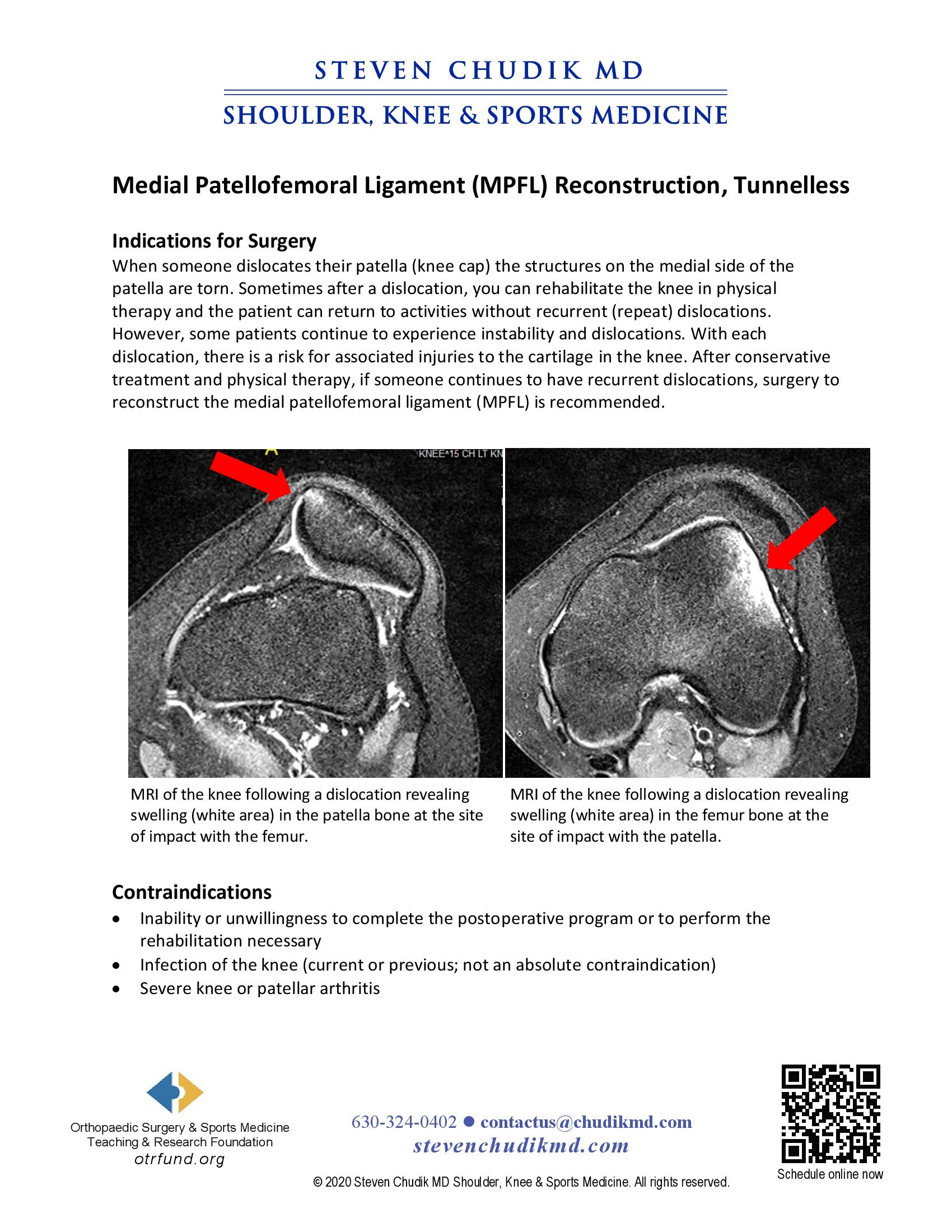 Medial Patellofemoral Ligament (MPFL) Tunnelless Reconstruction ...