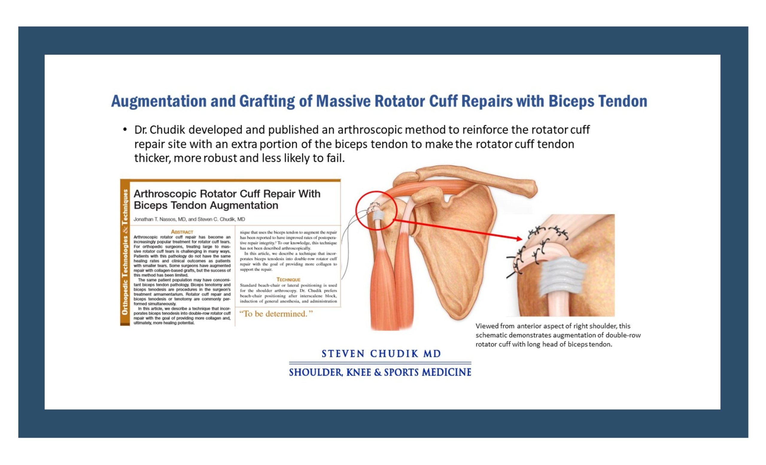 https://www.stevenchudikmd.com/wp-content/uploads/2023/06/Chicago-shoulder-surgeon_Chicago-sports-medicine-specialist_Dr-Steven-Chudik-special-procedure_Augmentation-graft-of-massive-rotator-cuff-repair-with-biceps-tendon-1-scaled.jpg