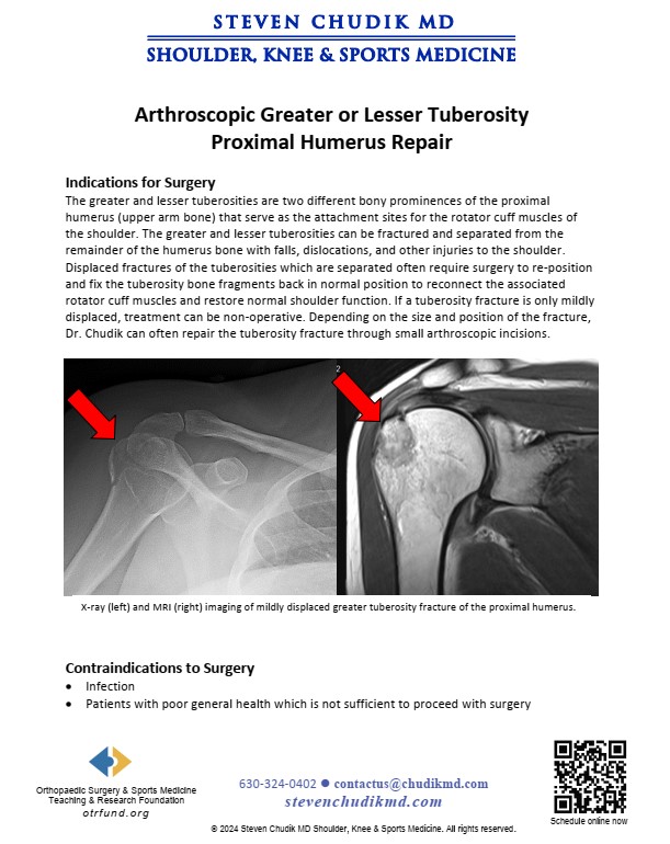 Arthroscopic Proximal Humerus Greater Tuberosity Fracture Repair ...
